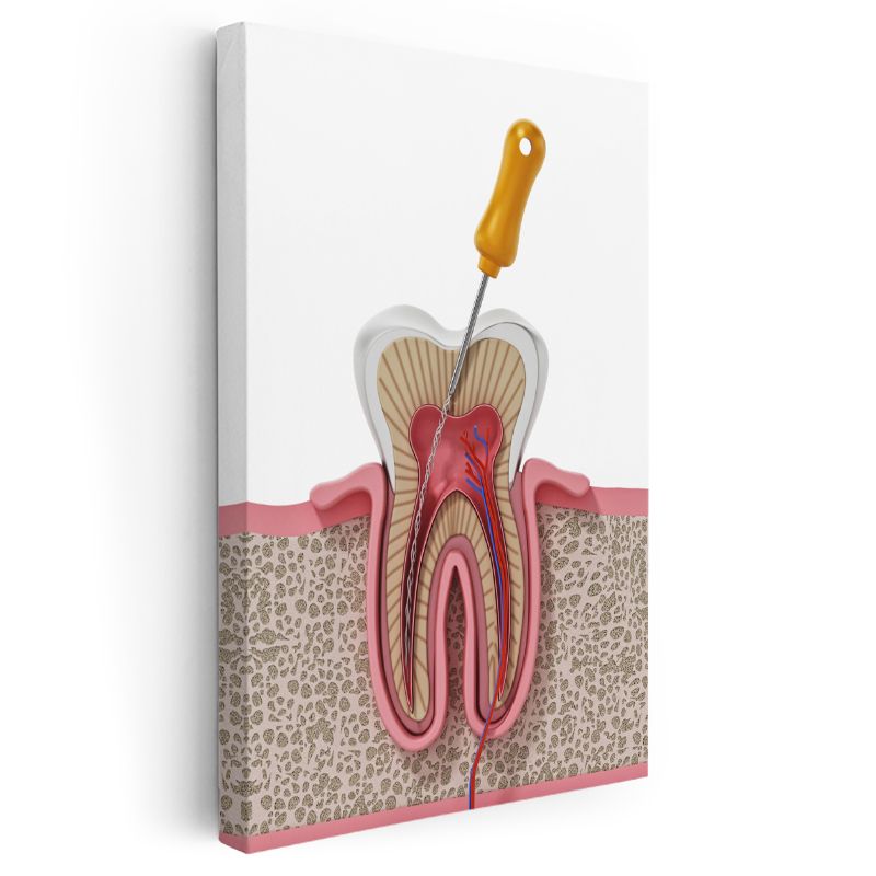 Diş Hekimi - Kök Kanal Tedavisi ve Diş Anatomisi Kanvas Tablo