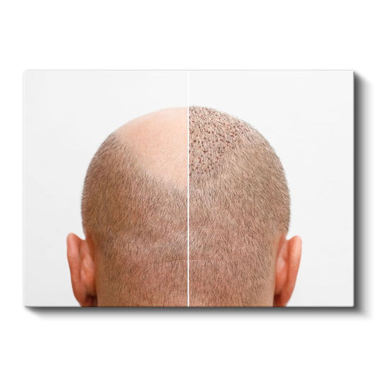 Saç Ekimi Uzmanı - Yeni Başlangıç Kanvas Tablo