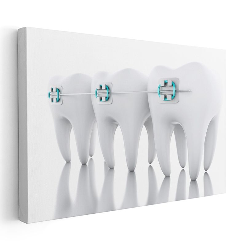 Ortodontist - Modern Ortodonti Teknikleri Kanvas Tablo