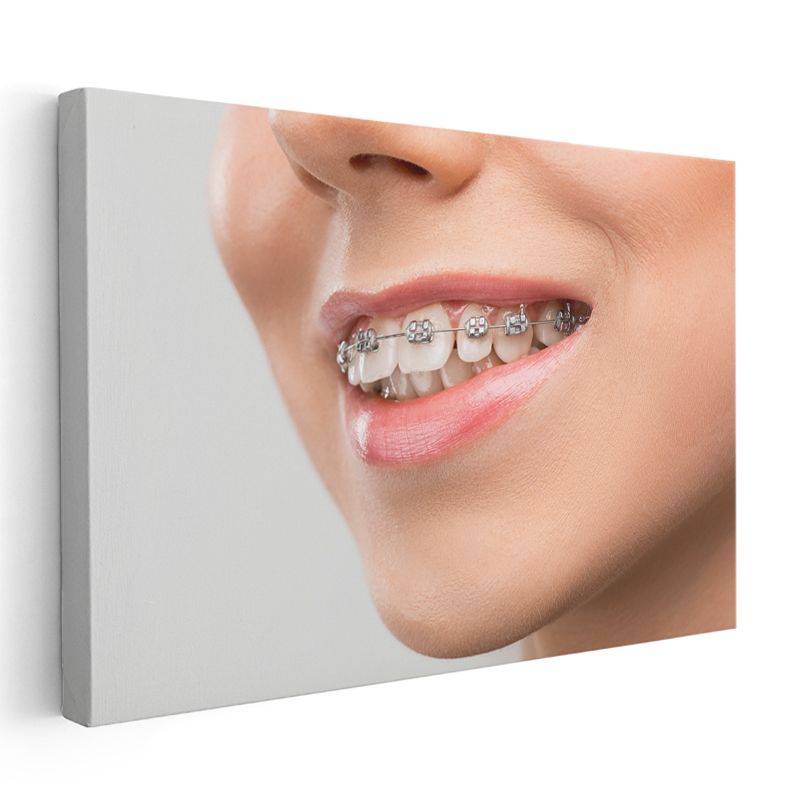 Ortodontist - Gülüş Tasarımı Kanvas Tablo
