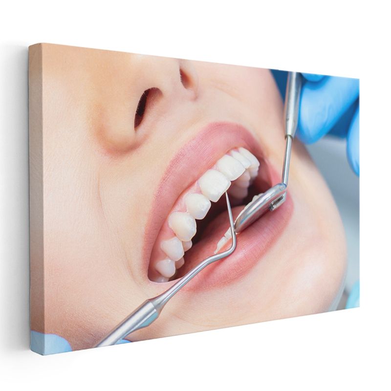 Diş Hekimi - Ağız Bakımı Kontrolü Kanvas Tablo