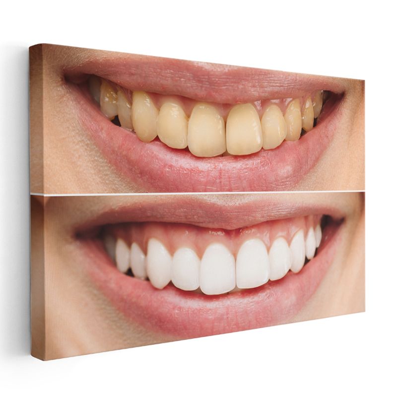 Diş Hekimi - Modern Diş Beyazlatma Teknikleri ve Uygulamaları Kanvas Tablo