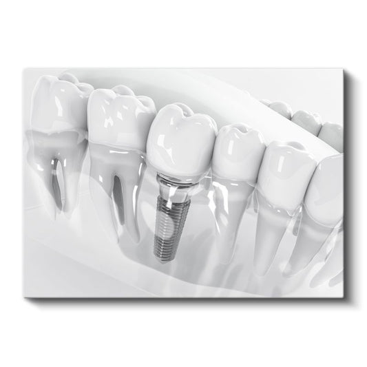 Diş Hekimi - İmplant Protez Uygulaması Kanvas Tablo