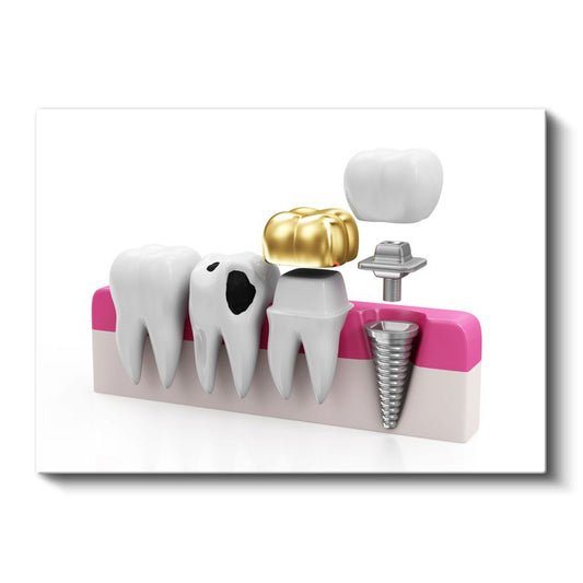 Diş Hekimi - İmplant ve Protez Teknolojisi Kanvas Tablo