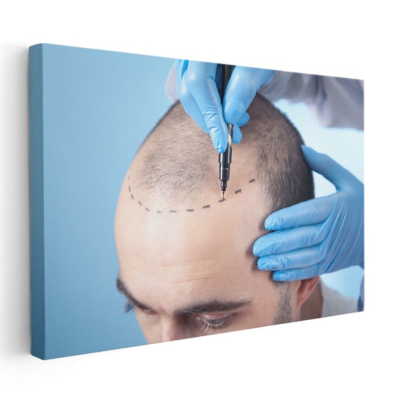 Estetik Cerrah - Saç Ekimi Operasyonu Kanvas Tablo