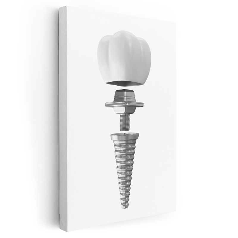 Diş Protez Uzmanı - İmplant Sistemi Kanvas Tablo