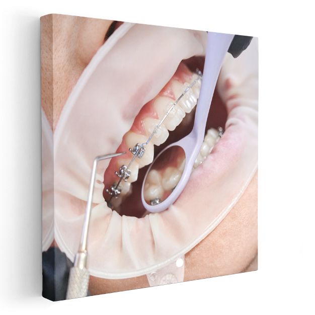 Ortodontist - Diş Teli Uygulaması ve Tedavi Süreci Kanvas Tablo
