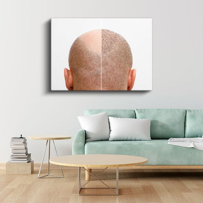 Saç Ekimi Uzmanı - Yeni Başlangıç Kanvas Tablo