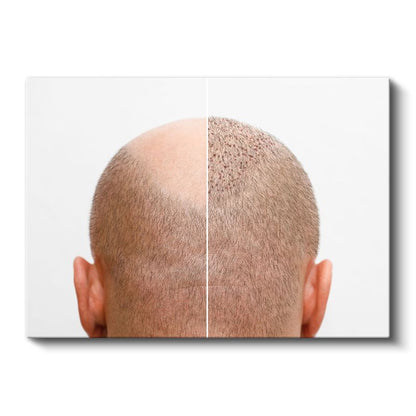 Saç Ekimi Uzmanı - Yeni Başlangıç Kanvas Tablo