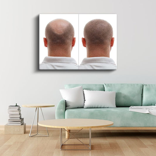 Saç Ekimi Uzmanı - Saç Dökülmesi Tedavisi Kanvas Tablo