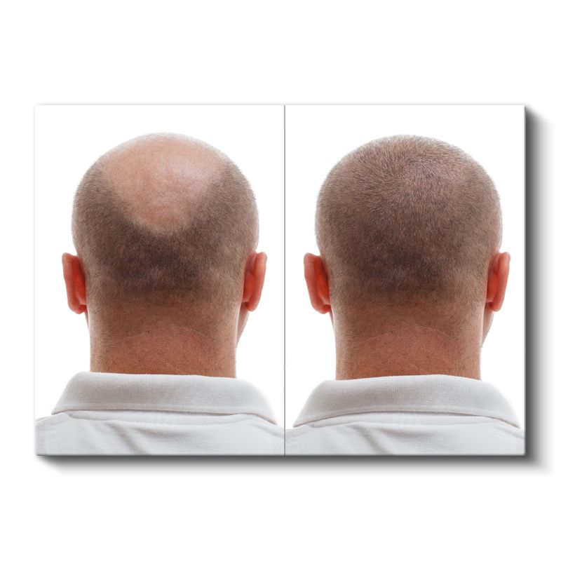Saç Ekimi Uzmanı - Saç Dökülmesi Tedavisi Kanvas Tablo