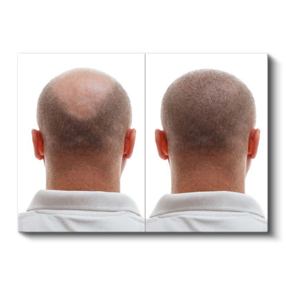 Saç Ekimi Uzmanı - Saç Dökülmesi Tedavisi Kanvas Tablo