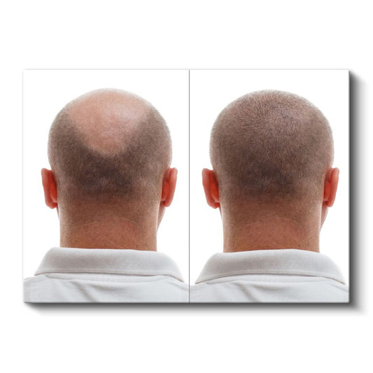 Saç Ekimi Uzmanı - Saç Dökülmesi Tedavisi Kanvas Tablo