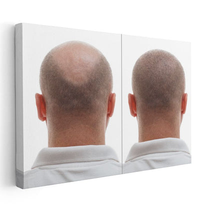 Saç Ekimi Uzmanı - Saç Dökülmesi Tedavisi Kanvas Tablo