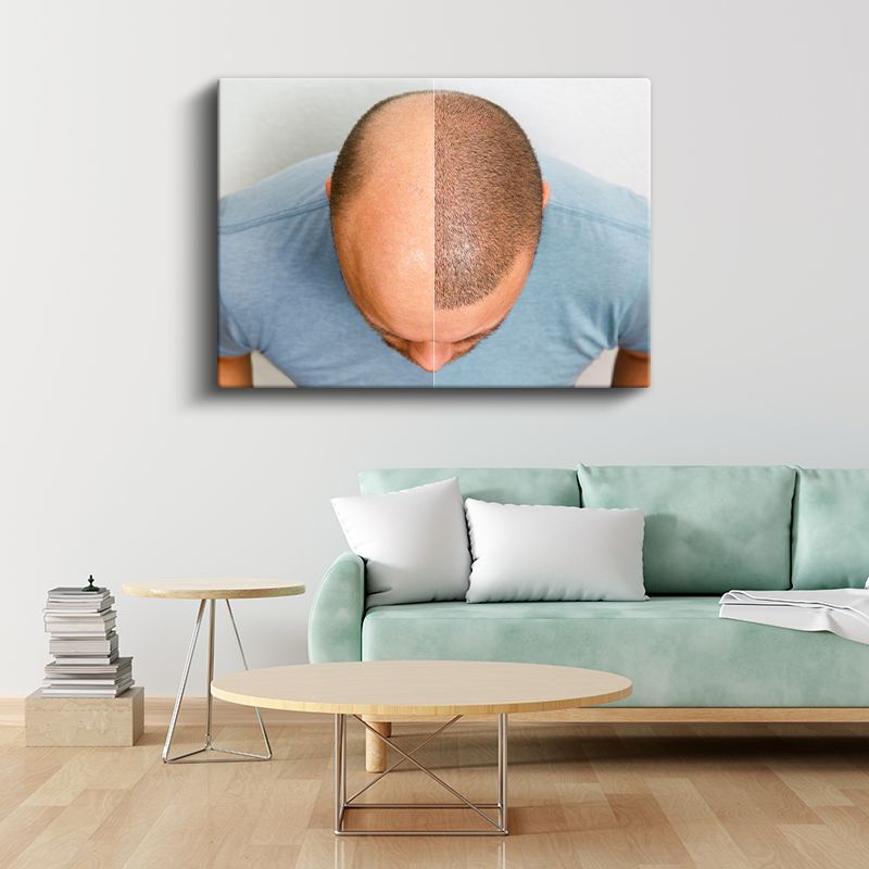 Saç Ekimi Uzmanı - Saç Yoğunluğu Artırma Kanvas Tablo