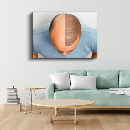 Saç Ekimi Uzmanı - Saç Yoğunluğu Artırma Kanvas Tablo