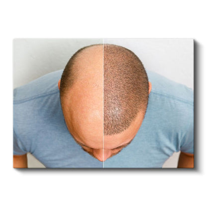 Saç Ekimi Uzmanı - Saç Yoğunluğu Artırma Kanvas Tablo