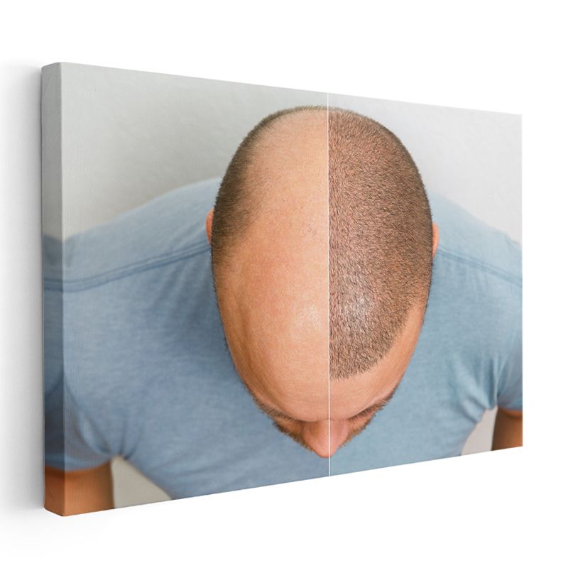 Saç Ekimi Uzmanı - Saç Yoğunluğu Artırma Kanvas Tablo