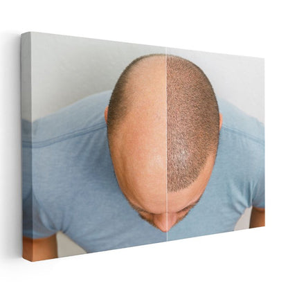 Saç Ekimi Uzmanı - Saç Yoğunluğu Artırma Kanvas Tablo