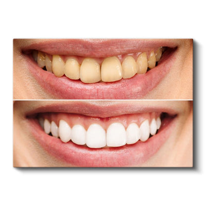 Diş Hekimi - Modern Diş Beyazlatma Teknikleri ve Uygulamaları Kanvas Tablo