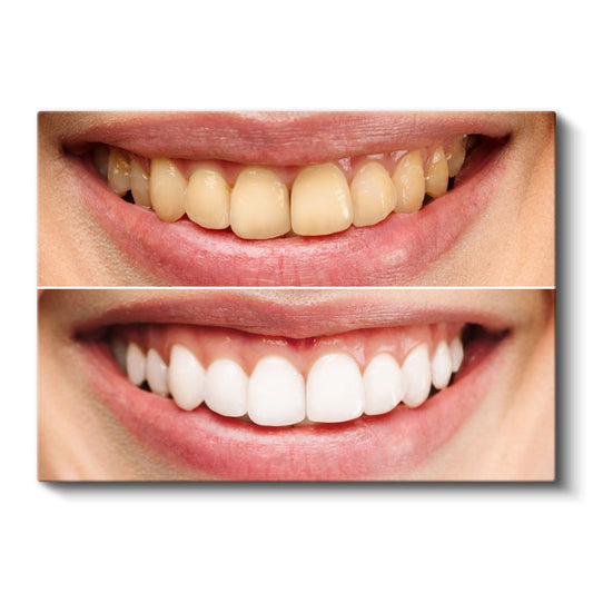 Diş Hekimi - Modern Diş Beyazlatma Teknikleri ve Uygulamaları Kanvas Tablo