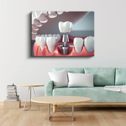 Diş Hekimi - İleri İmplant Teknolojisi ve Uygulamaları Kanvas Tablo