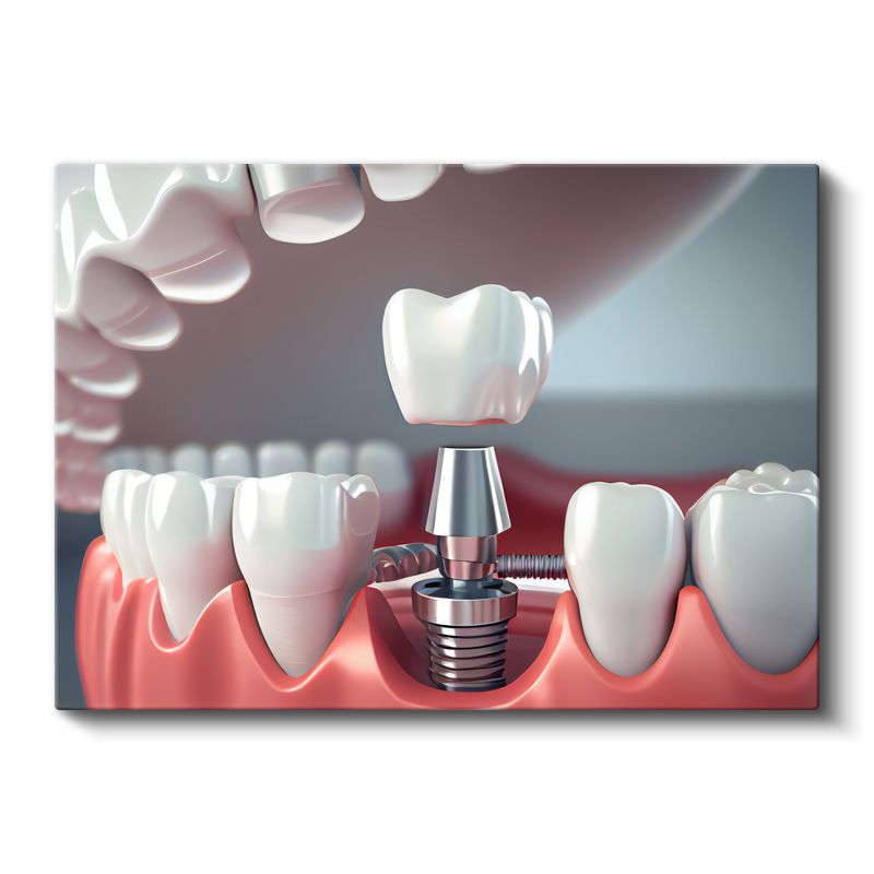 Diş Hekimi - İleri İmplant Teknolojisi ve Uygulamaları Kanvas Tablo