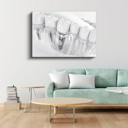 Diş Hekimi - İmplant Protez Uygulaması Kanvas Tablo