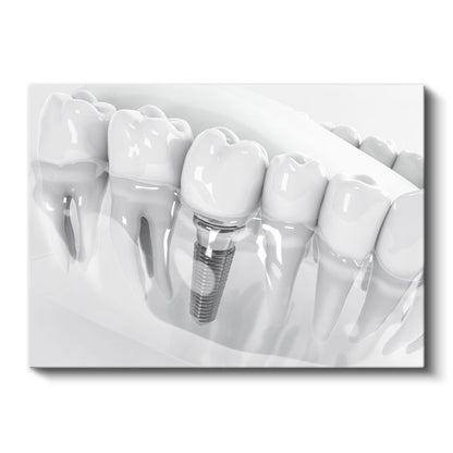Diş Hekimi - İmplant Protez Uygulaması Kanvas Tablo