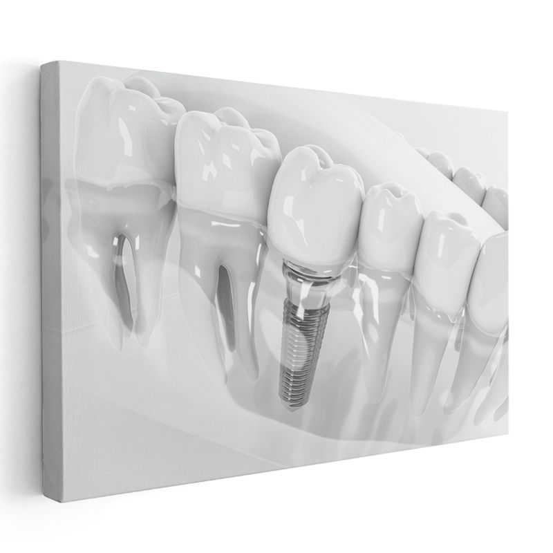 Diş Hekimi - İmplant Protez Uygulaması Kanvas Tablo