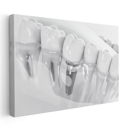 Diş Hekimi - İmplant Protez Uygulaması Kanvas Tablo