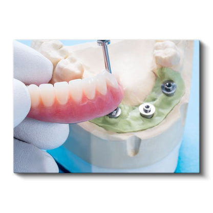 Diş Hekimi - İmplant Yerleştirme Tekniği Kanvas Tablo