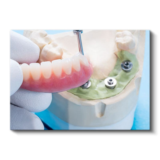 Diş Hekimi - İmplant Yerleştirme Tekniği Kanvas Tablo