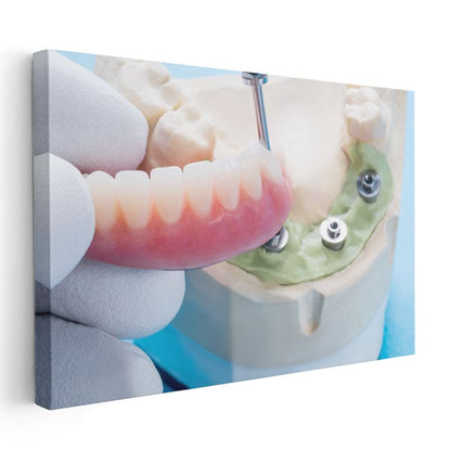 Diş Hekimi - İmplant Yerleştirme Tekniği Kanvas Tablo