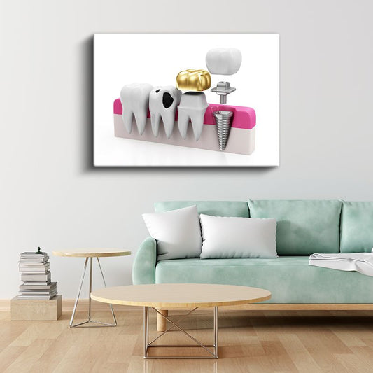 Diş Hekimi - İmplant ve Protez Teknolojisi Kanvas Tablo
