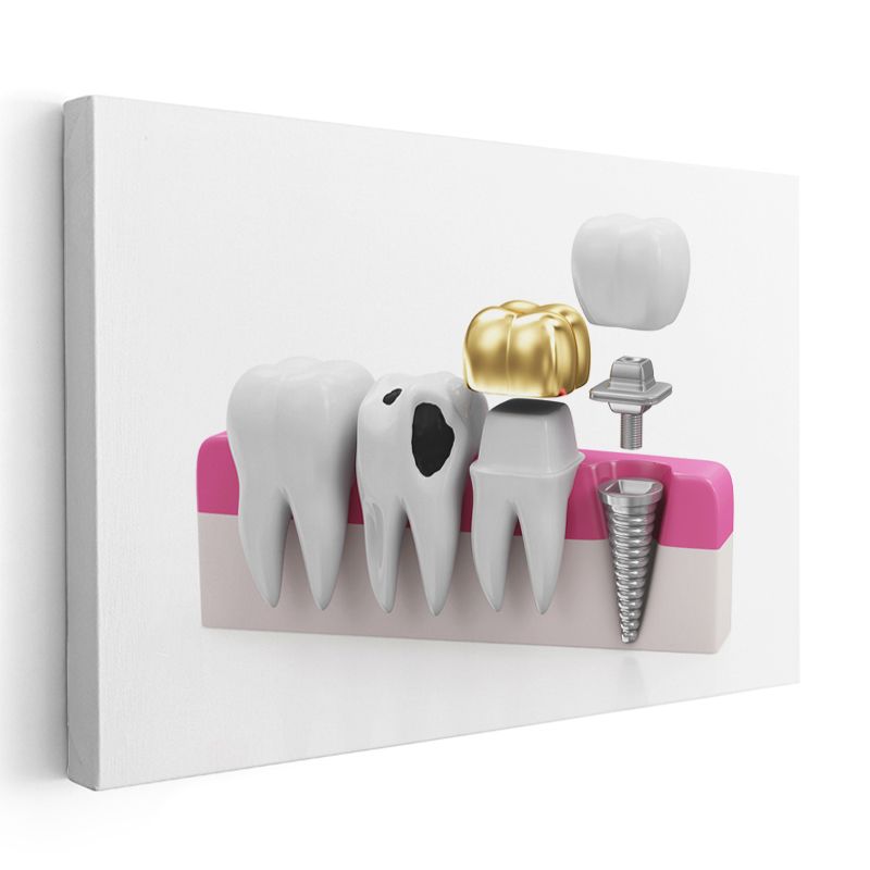 Diş Hekimi - İmplant ve Protez Teknolojisi Kanvas Tablo