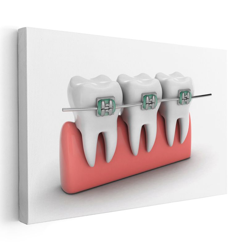 Ortodontist - Çağdaş Diş Teli Sistemleri ve Tedavi Yöntemleri Kanvas Tablo