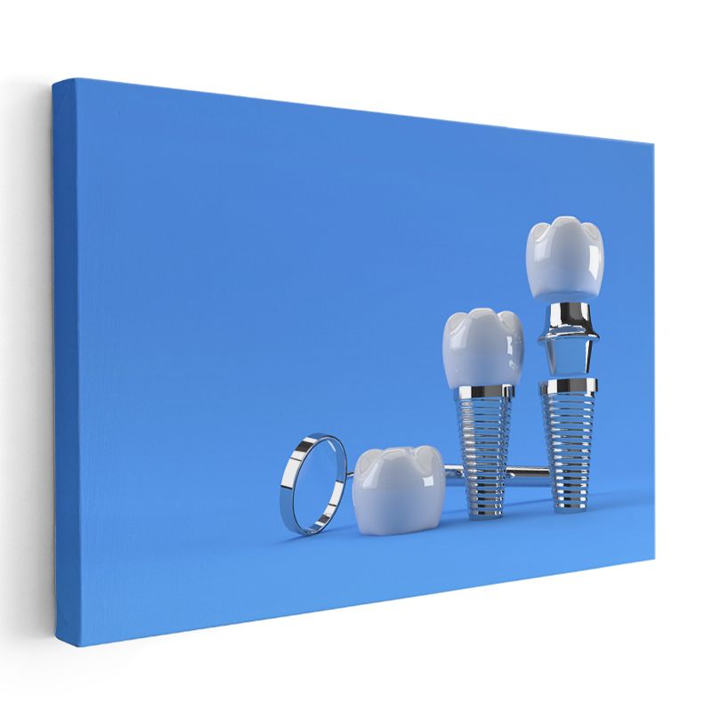 Diş Hekimi - Modern İmplant Cerrahisi ve Rehabilitasyon Kanvas Tablo