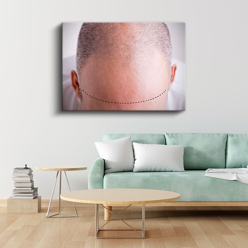 Saç Ekimi Uzmanı - Ekim Hattı Planlama Kanvas Tablo