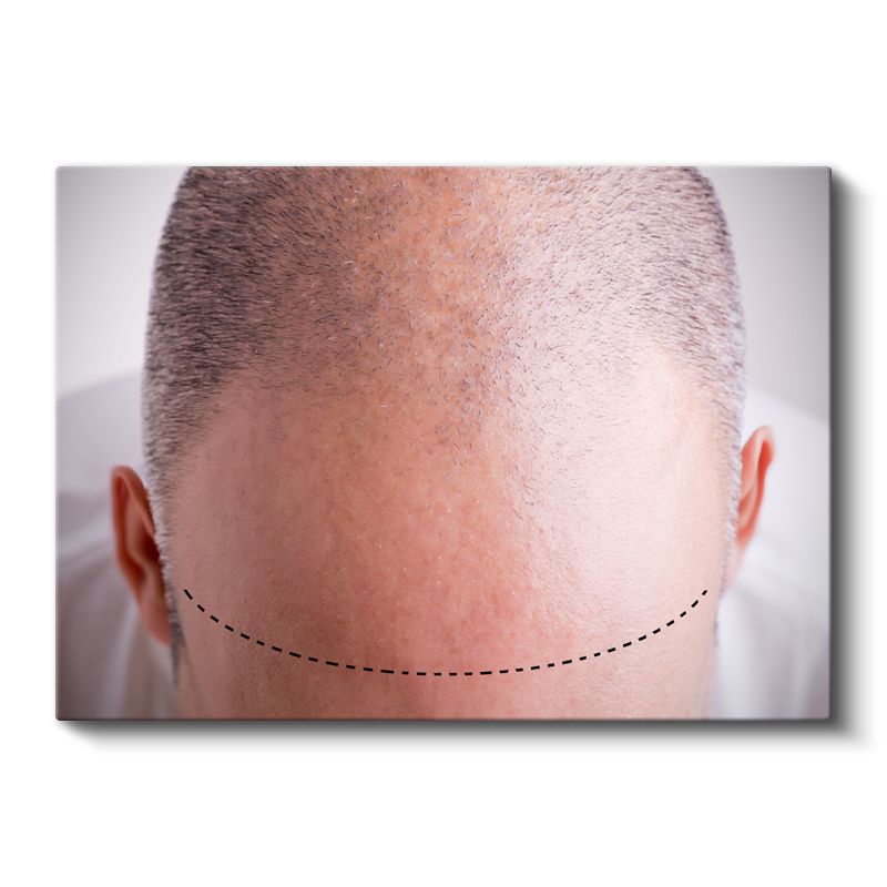 Saç Ekimi Uzmanı - Ekim Hattı Planlama Kanvas Tablo