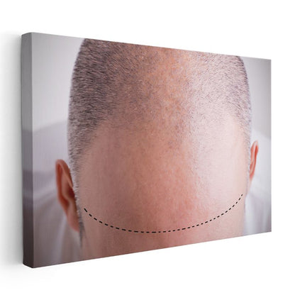 Saç Ekimi Uzmanı - Ekim Hattı Planlama Kanvas Tablo