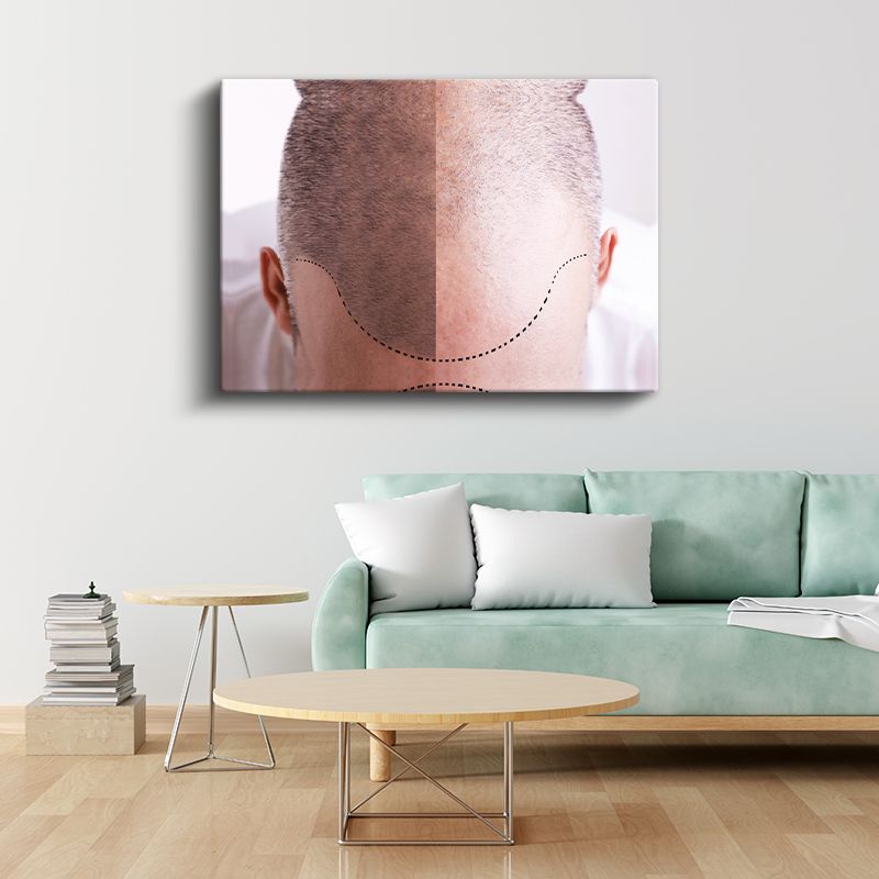 Saç Ekimi Uzmanı - Saç Transplantasyonu Kanvas Tablo