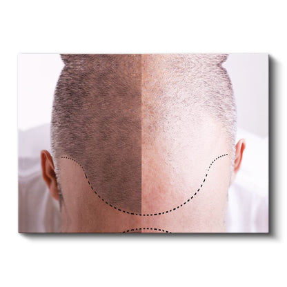 Saç Ekimi Uzmanı - Saç Transplantasyonu Kanvas Tablo
