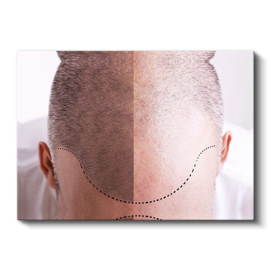 Saç Ekimi Uzmanı - Saç Transplantasyonu Kanvas Tablo