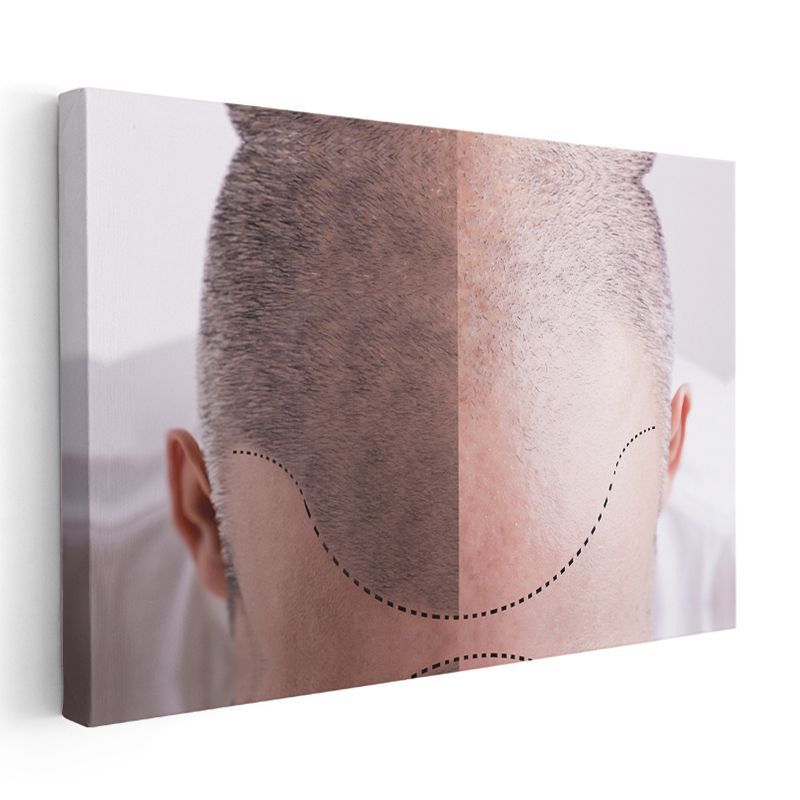 Saç Ekimi Uzmanı - Saç Transplantasyonu Kanvas Tablo