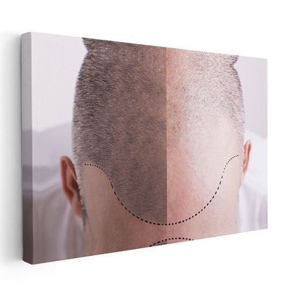 Saç Ekimi Uzmanı - Saç Transplantasyonu Kanvas Tablo
