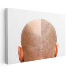 Yatay Kanvas Tablo Saç Ekimi Öncesi Sonrası Saç Ekim Uzmanı Tablosu Ev Ofis Duvar Dekoru