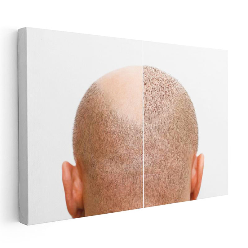 Yatay Kanvas Tablo Saç Ekimi Öncesi Sonrası Saç Ekim Uzmanı Tablosu Ev Ofis Duvar Dekoru