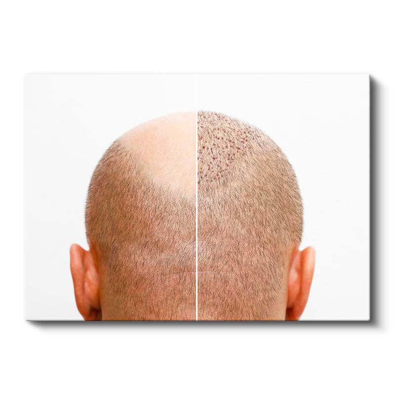Yatay Kanvas Tablo Saç Ekimi Öncesi Sonrası Saç Ekim Uzmanı Tablosu Ev Ofis Duvar Dekoru