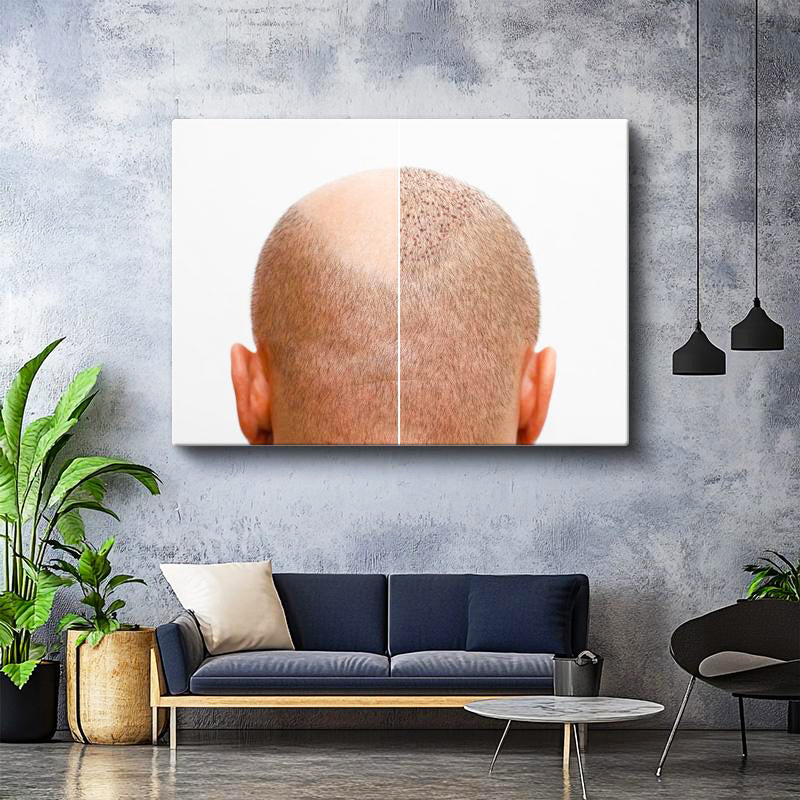 Yatay Kanvas Tablo Saç Ekimi Öncesi Sonrası Saç Ekim Uzmanı Tablosu Ev Ofis Duvar Dekoru